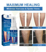 Varicose Vein Spray - OUHOE - Image 5