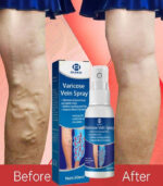 Varicose Vein Spray - OUHOE - Image 3